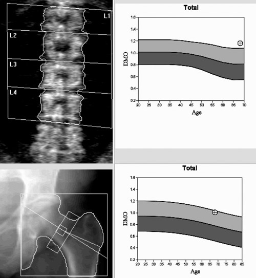 image osteodensitometrie